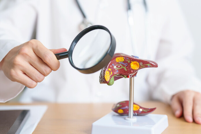 Steatoze nozīmē to, ka aknu šūnās – hepatocītos – sakrājušies tauku pilieniņi.