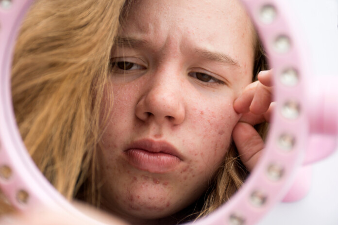 Vecākiem ir svarīgi izrādīt interesi un palīdzēt, lai ar akni tiktu galā fiziski un emocionāli.