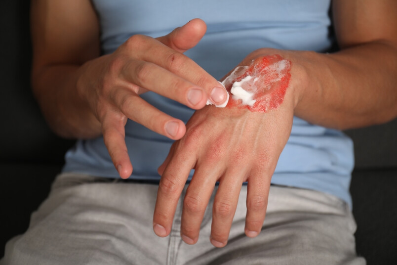 Apdegumi ir audu bojājumi, kas radušies augstas temperatūras, kodīgu ķīmisku vielu, elektriskās strāvas vai radioaktīvu vielu iedarbībā.