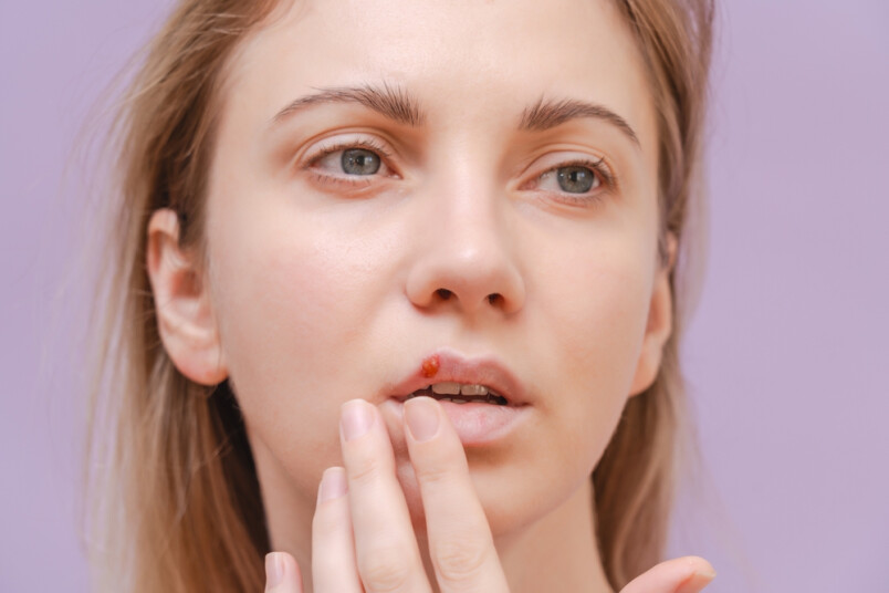 Aukstumpumpas izraisa vīruss, kas daudziem cilvēkiem jau ir organismā.