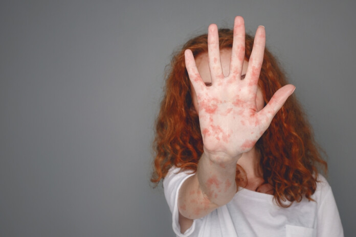 Masalas vēl nav palikušas pagātnē.