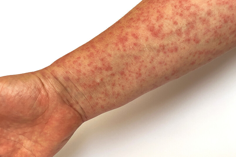 Latvijā turpmākās infekcijas izplatīšanas risks, jo īpaši nevakcinēto personu vidū, vērtējams kā augsts.