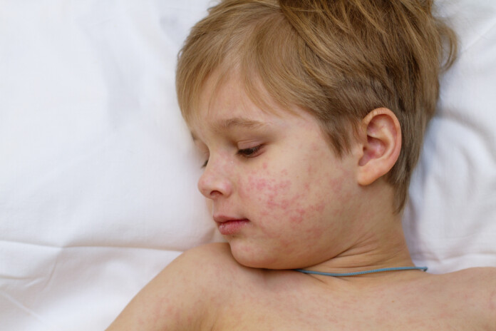 Bērnu saslimšana ar masalām