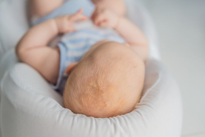 Piena krevelīte jeb seborejiskais dermatīts