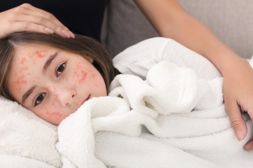 Visvairāk saslimušo bijis vecumā no sešiem līdz 15 gadiem.