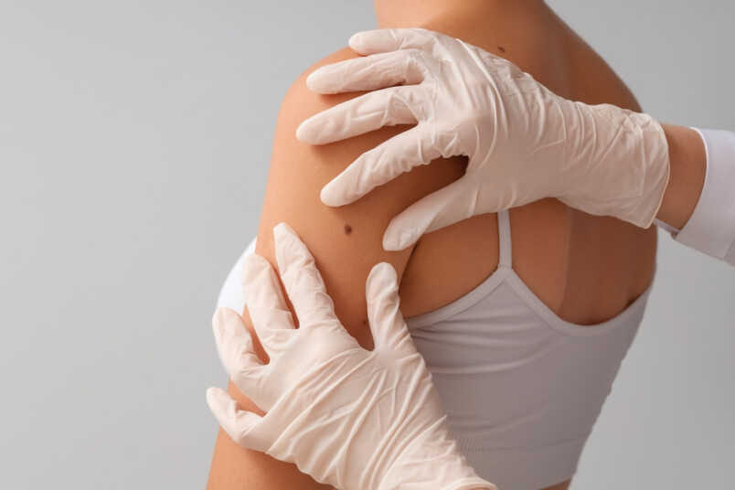 Melanoma