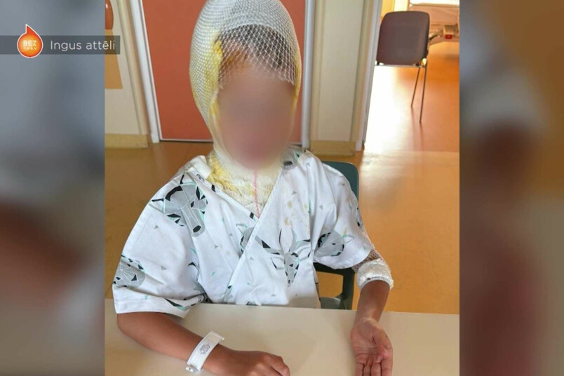 Septiņgadnieks sev uz galvas uzlējis karstu ūdeni, kā rezultātā guvis smagus apdegumus.